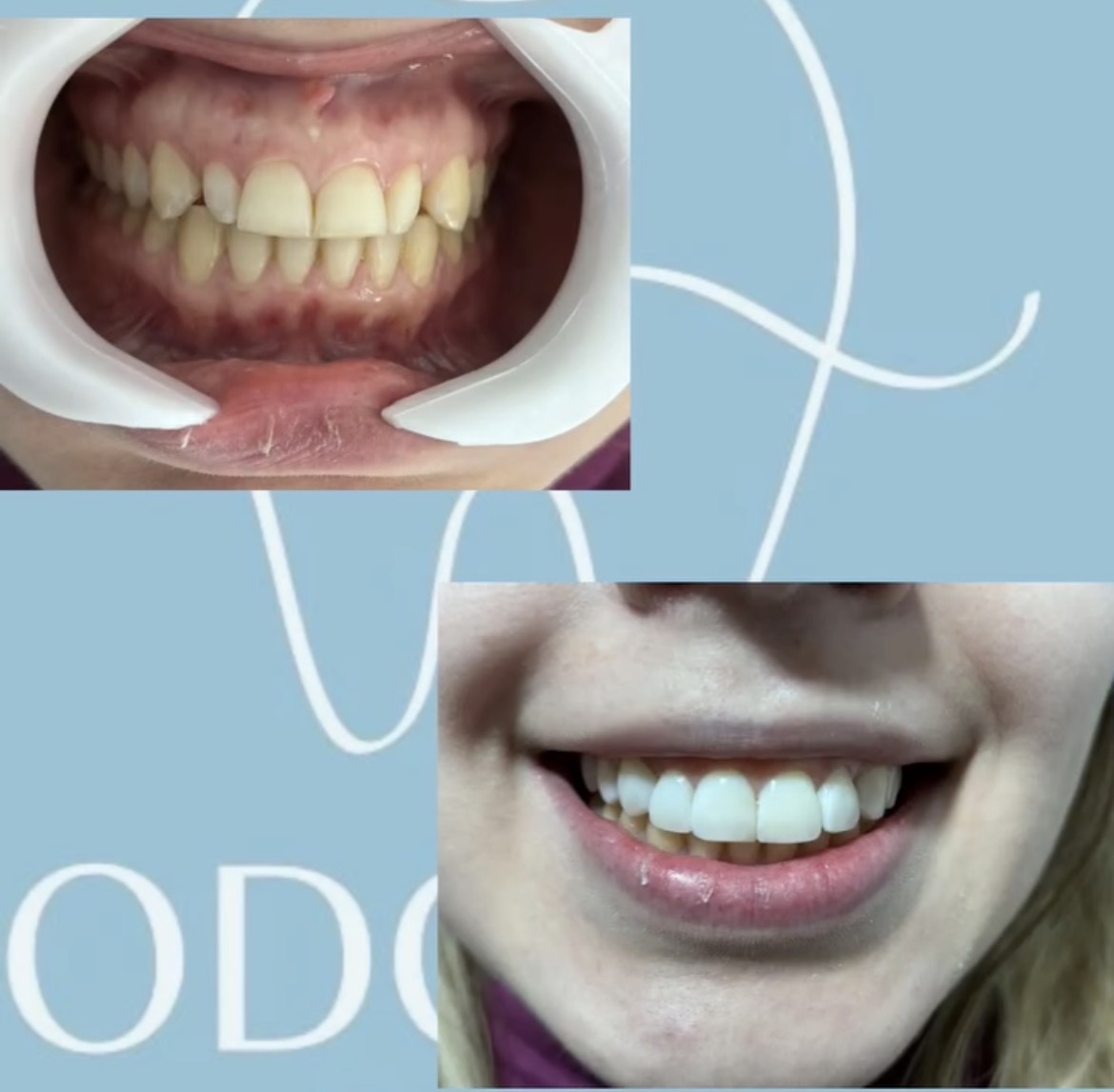 Antes y después tratamiento dental 1
